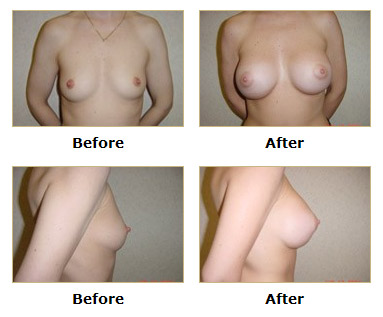 dermatology and surgery associates tummy tuck liposuction before and after bronx ny