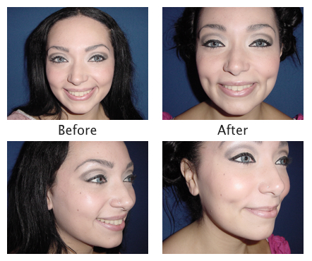 dermatology and surgery associates mommy makeover before and after bronx ny
